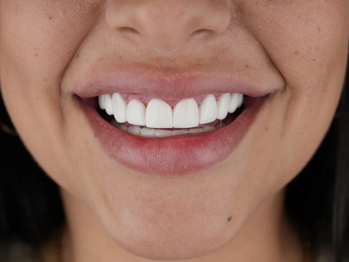 After — Porcelain Veneers — Smile Dental Center