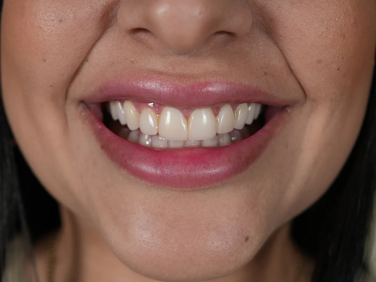 Before — Porcelain Veneers — Smile Dental Center