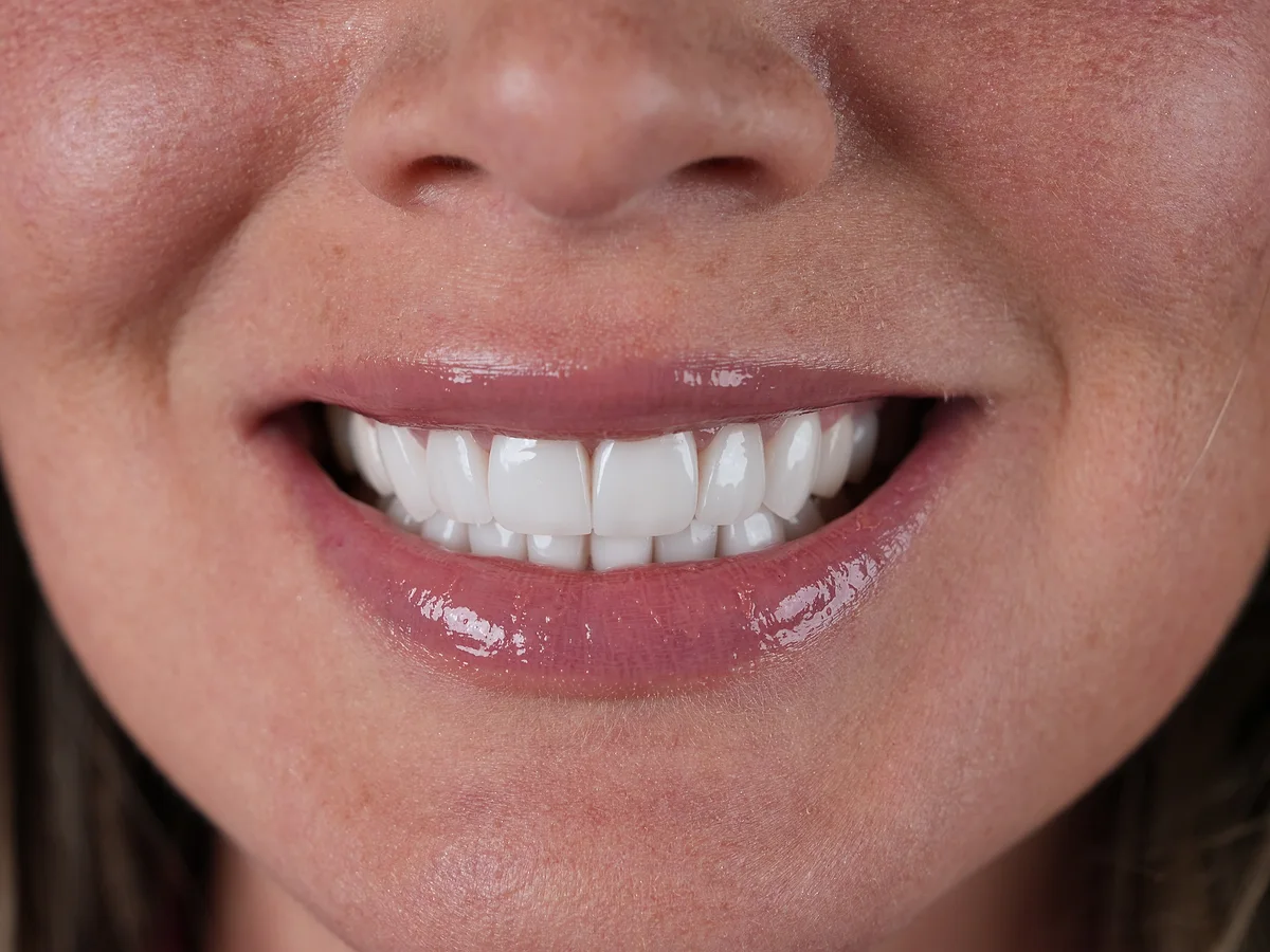After — Full Set e.max Veneers — Smile Dental Center