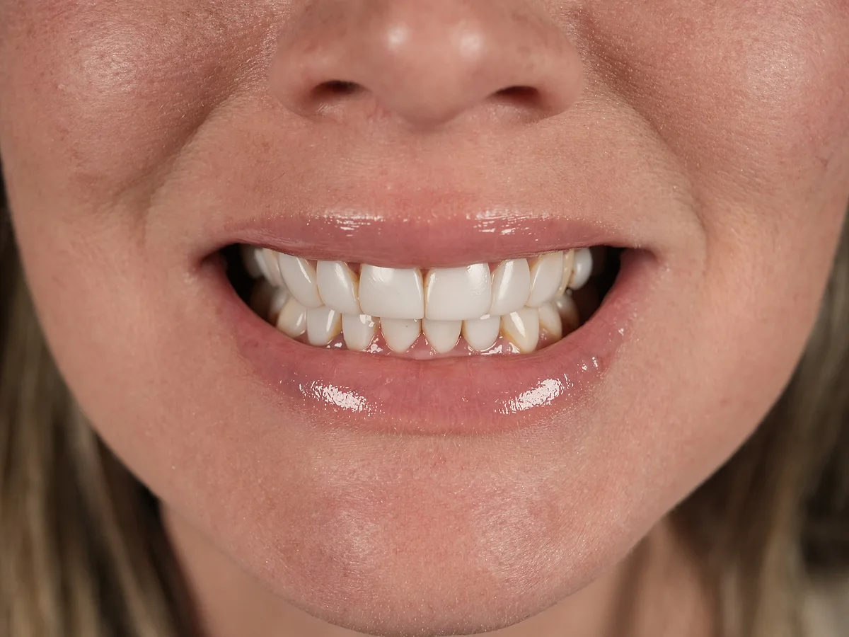 Before — Full Set e.max Veneers — Smile Dental Center