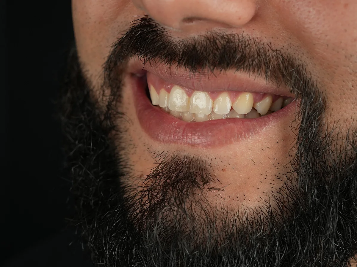 Before — Smile Makeover with Porcelain Veneers