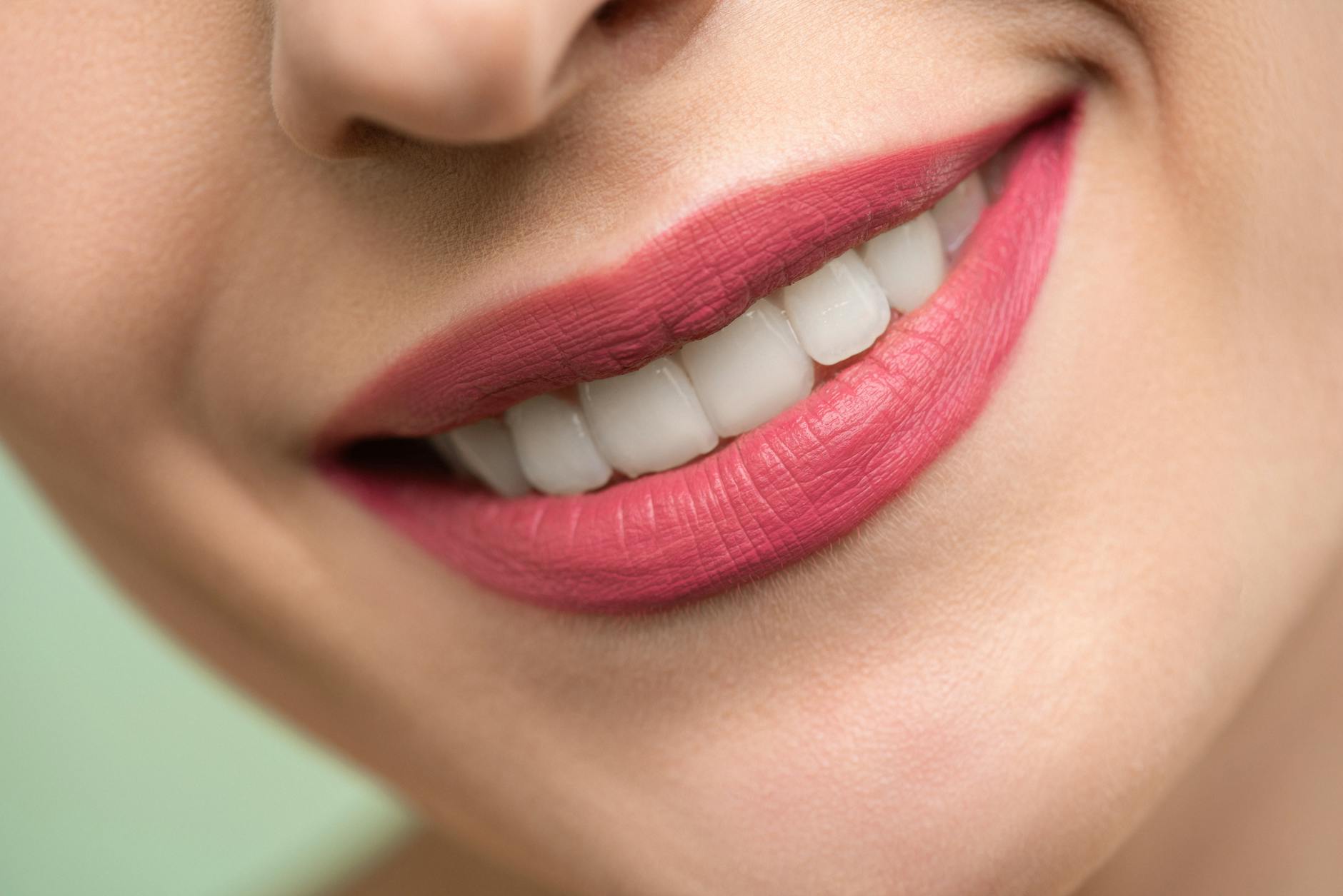 porcelain-veneers gallery 6